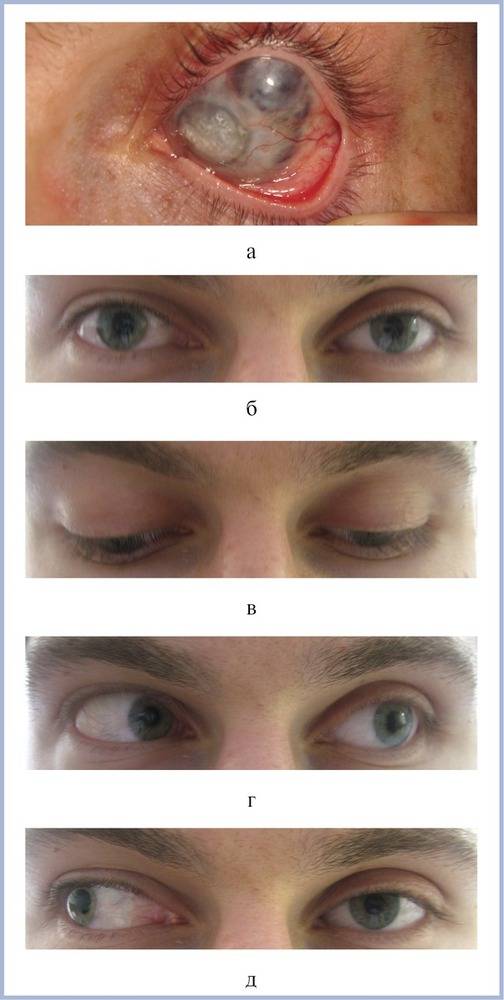 Энуклеация глаза: суть операции, противопоказания, осложнения