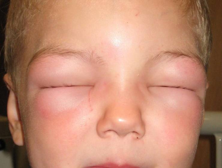 Как быстро снять аллергический отек с глаз
