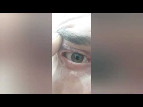 Мутно видит половина глаза после удаления металической стружки - вопрос офтальмологу - 03 онлайн