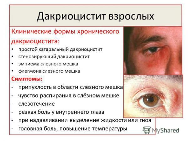 Слезоточивость глаз - причины и лечение