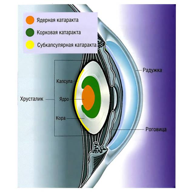 Ядерная катаракта: лечение и стадии созревания