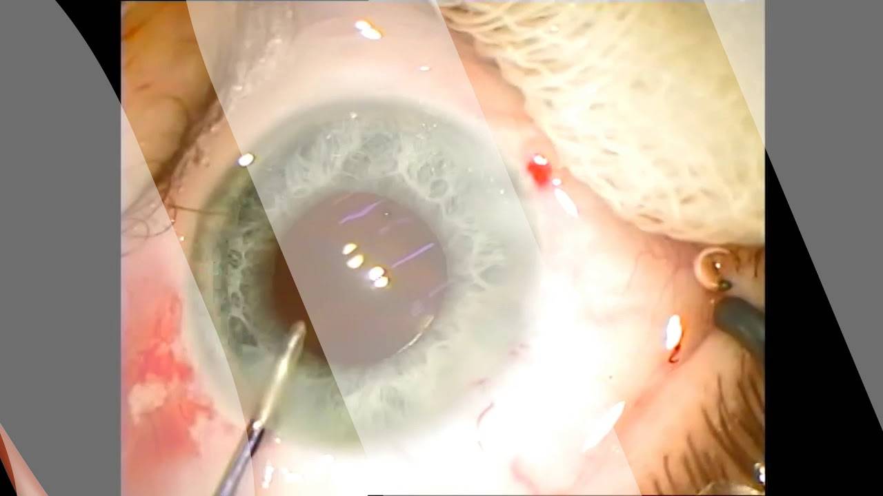 Факоэмульсификация катаракты - это операция с имплантацией, ультразвуковая, набор, послеоперационный период, иол, видео