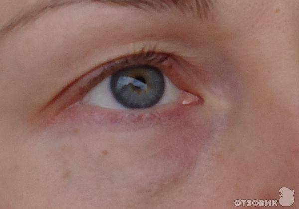 Синяки под глазами: причины, диагностика, лечение - "здоровое око"