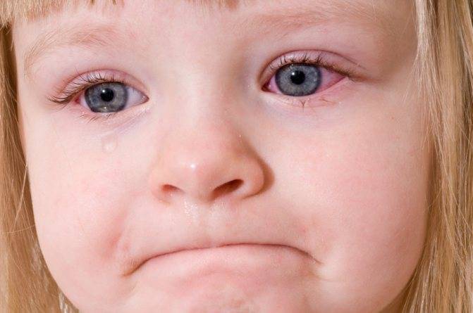 Виды гнойных конъюнктивитов у детей: как и чем лечить воспаление?