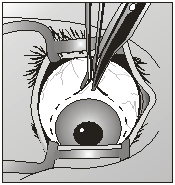 Эвисцерация – удаление содержимого глаза