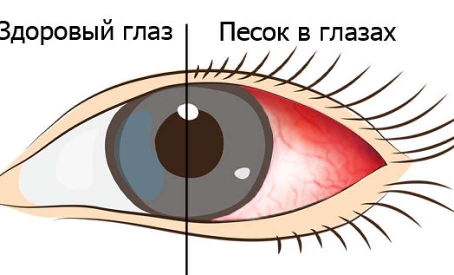 Ощущение песка в глазах: причины и лечение oculistic.ru
ощущение песка в глазах: причины и лечение