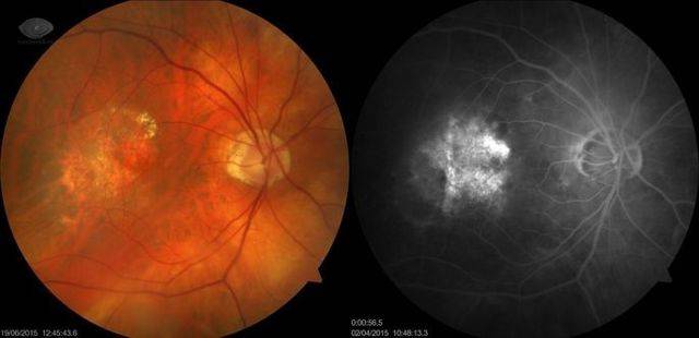 Ретиношизис сетчатки глаза: симптомы, лечение, причины, осложнения и профилактика