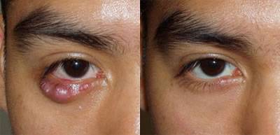 Удаление халязиона: показания и противопоказания - "здоровое око"