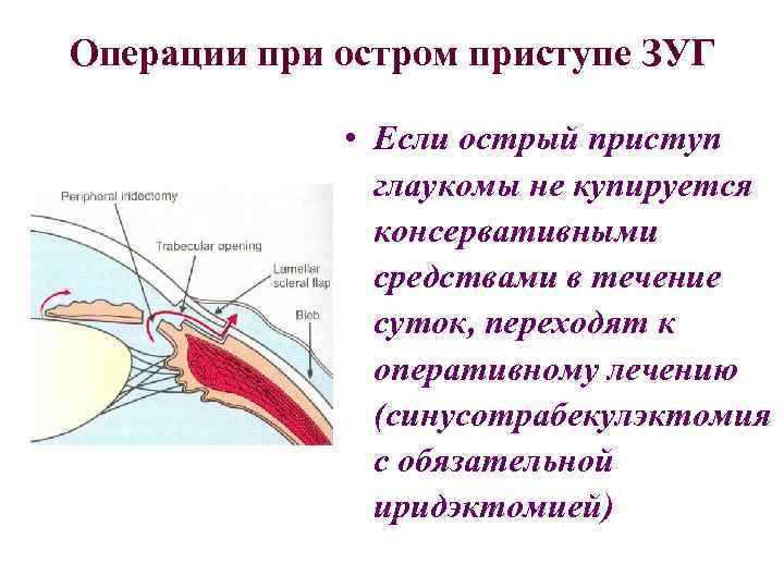 Острый приступ глаукомы: симптомы, неотложная помощь oculistic.ru
острый приступ глаукомы: симптомы, неотложная помощь