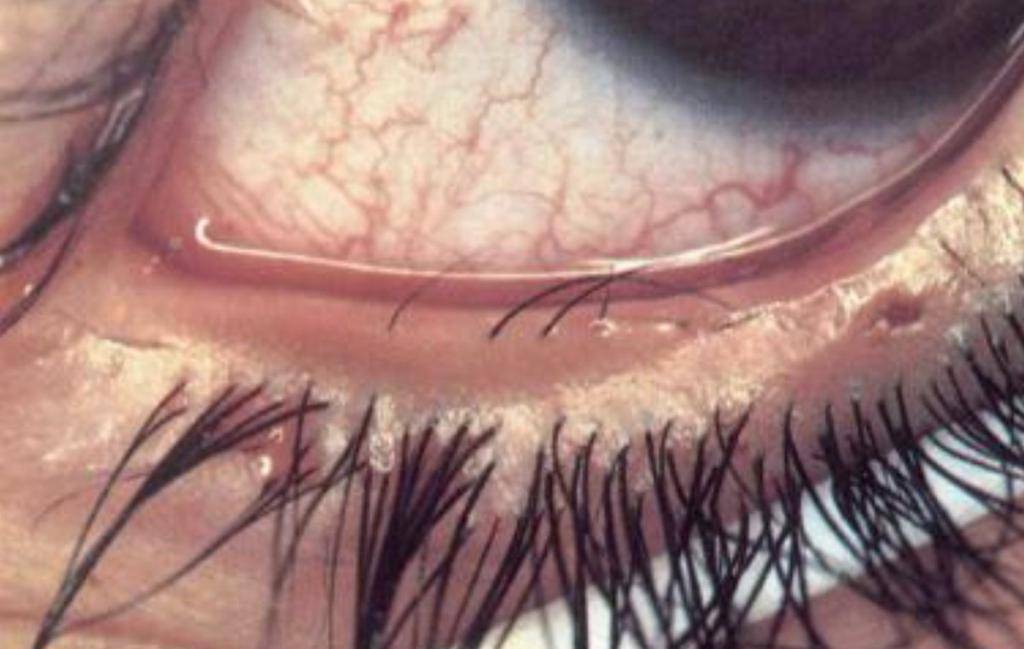 Трихиаз века глаза: симптомы, причины и лечение
