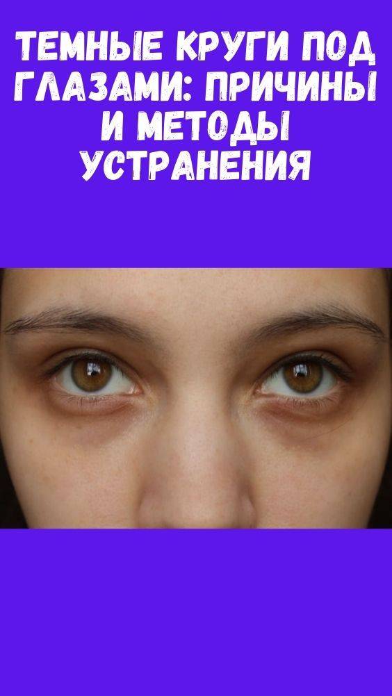 Причины темных кругов вокруг глаз у женщин. лечение в домашних условиях