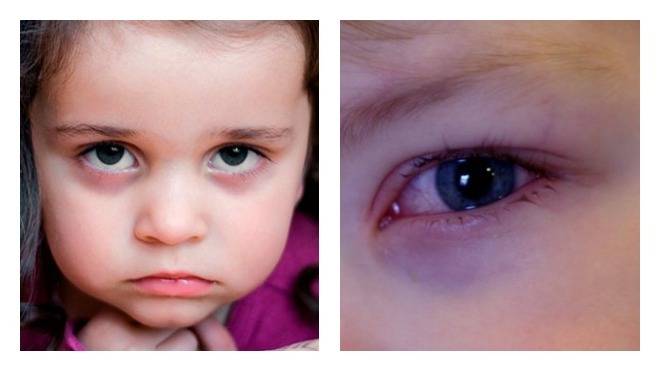 Доктор комаровский о синяках под глазами у ребенка