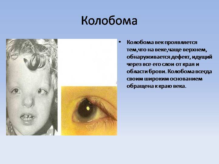 Колобома глаза – норма или патология, и как лечить?