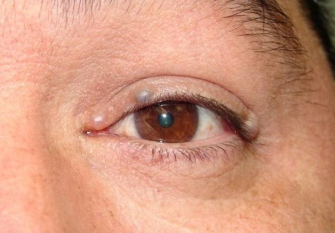 Киста глаза: симптомы и лечение - "здоровое око"