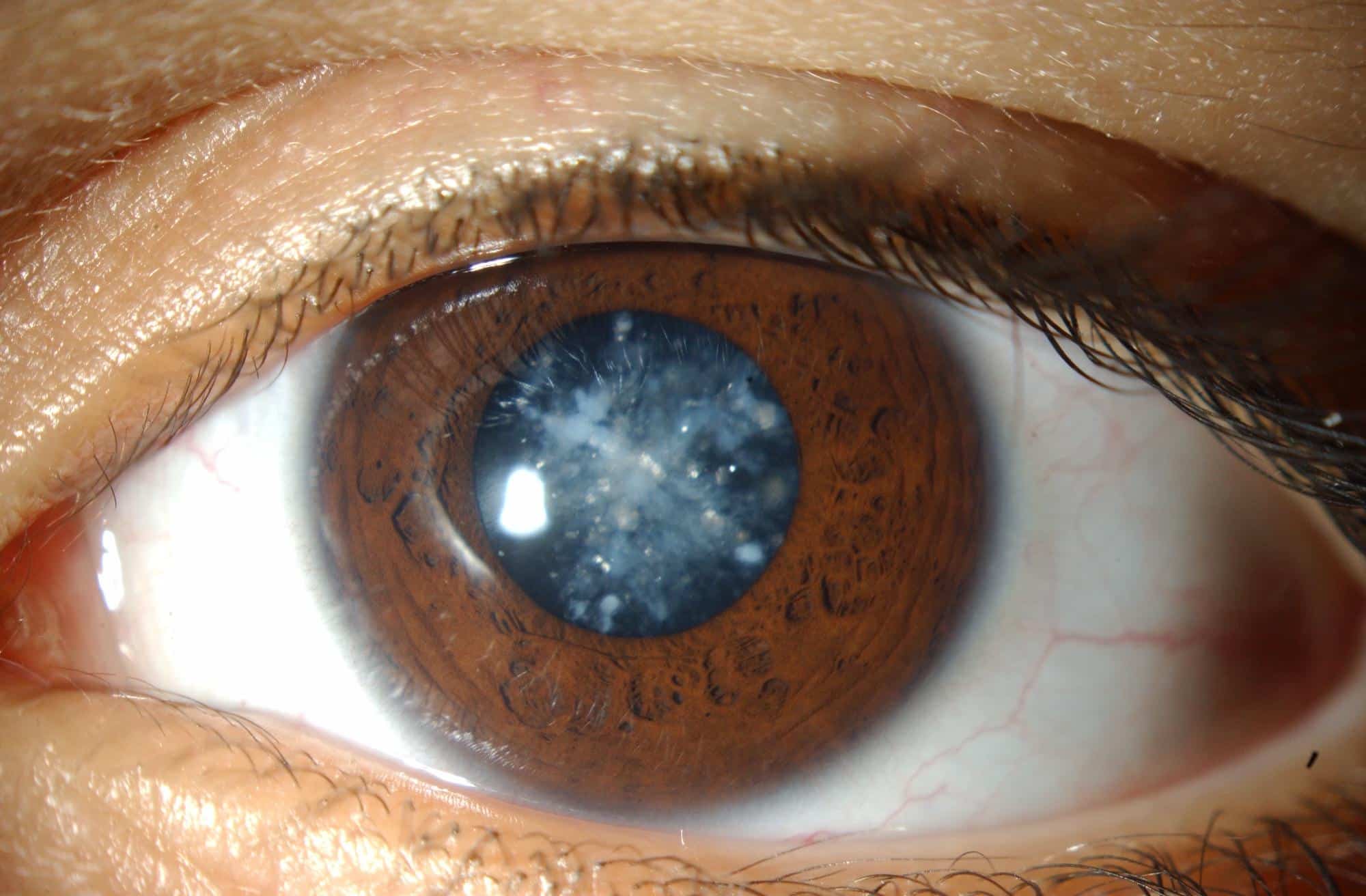 Катаракта глаза: что это такое, причины, первые признаки и симптомы, лечение помутнения хрусталика у взрослых людей