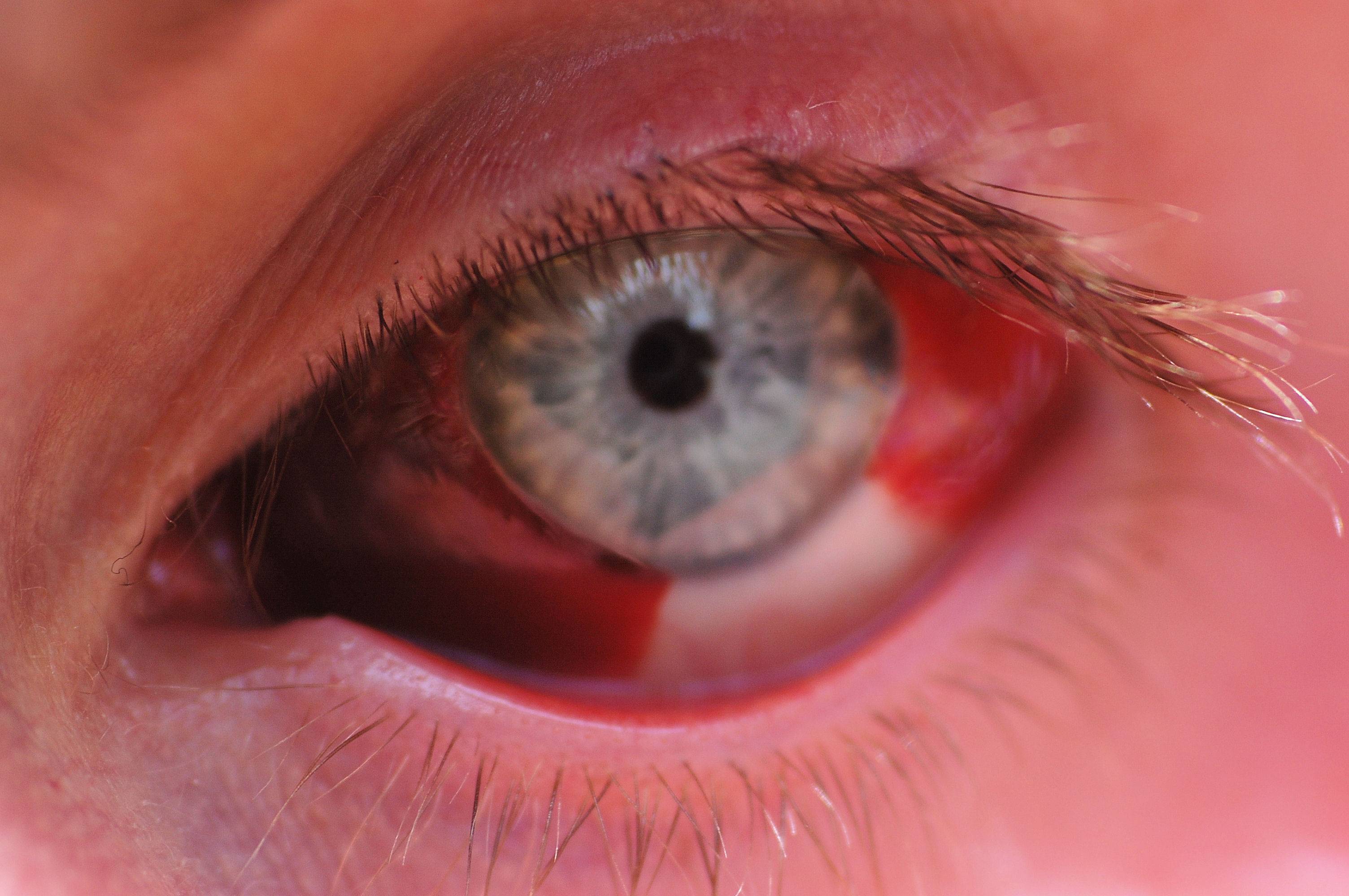 Красные сосуды в глазах: причины, лечение каплями, как избавиться народными средствами