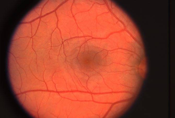 Фоновая ретинопатия