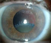 Современные виды операций при катаракте – показания для удаления катаракты