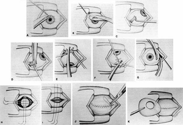 Лазерная коагуляция сетчатки глаза: показания, ход, последствия