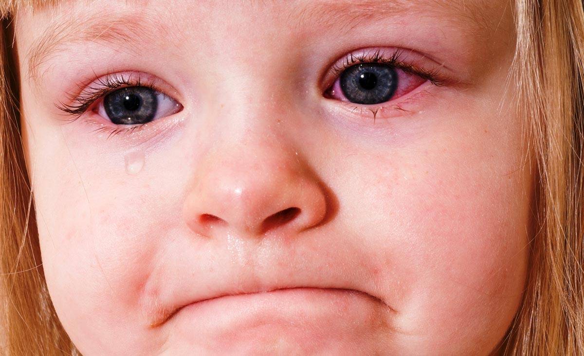 Глазные капли для детей от воспаления - показания к применению, чем лечить