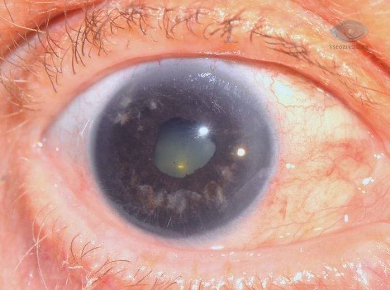 Вторичная некомпенсированная глаукома - вылечимглаукому