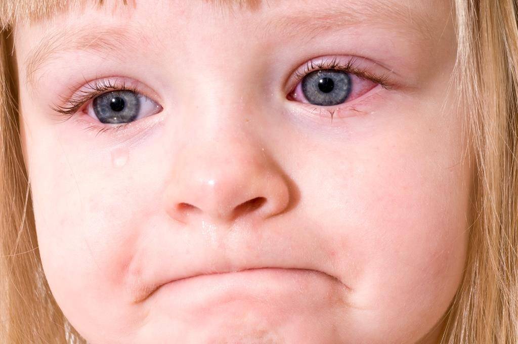 Острый конъюнктивит у детей: лечение глаз с воспалением, симптомы заболевания
