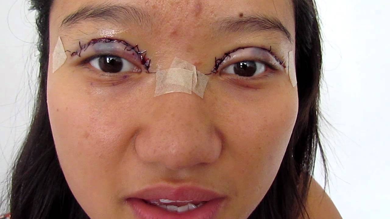 Какие может решить проблемы операция по увеличению глаз?