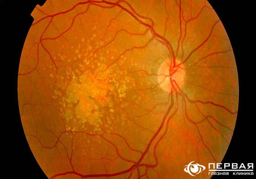 Макулодистрофия сетчатки глаза: симптомы, диагностика, лечение — глаза эксперт