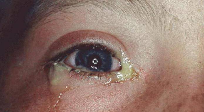 Гнойный конъюнктивит: симптомы и лечение - "здоровое око"