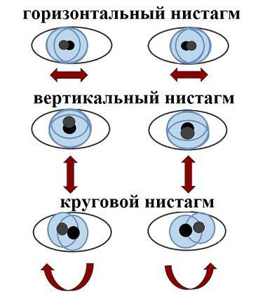 Что такое горизонтальный нистагм и как его лечить oculistic.ru
что такое горизонтальный нистагм и как его лечить