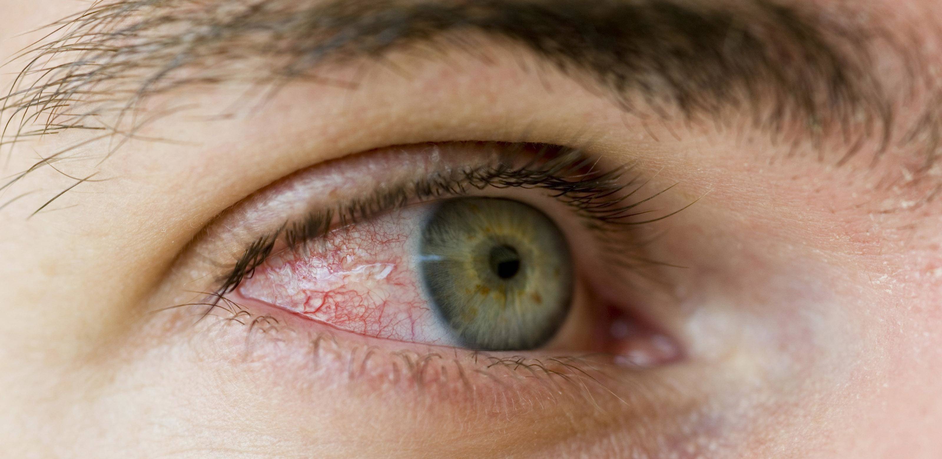 Повреждение роговицы глаза - что делать и как лечить?