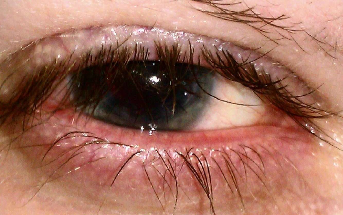 Блефарит глаза: симптомы и лечение, фото, причины возникновения, как вылечить у взрослых