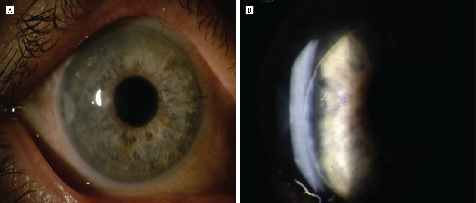 Заболевания роговицы глаза: причины, симптомы, лечение - "здоровое око"