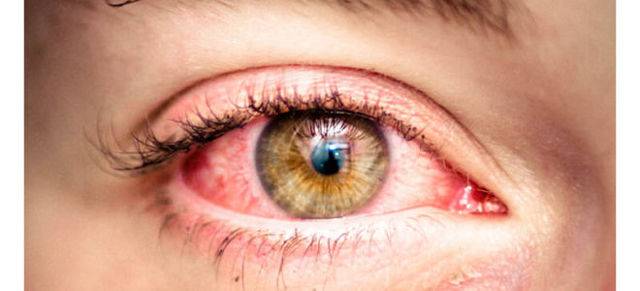 Болят глаза после сна утром - причины, лечение, симптомы