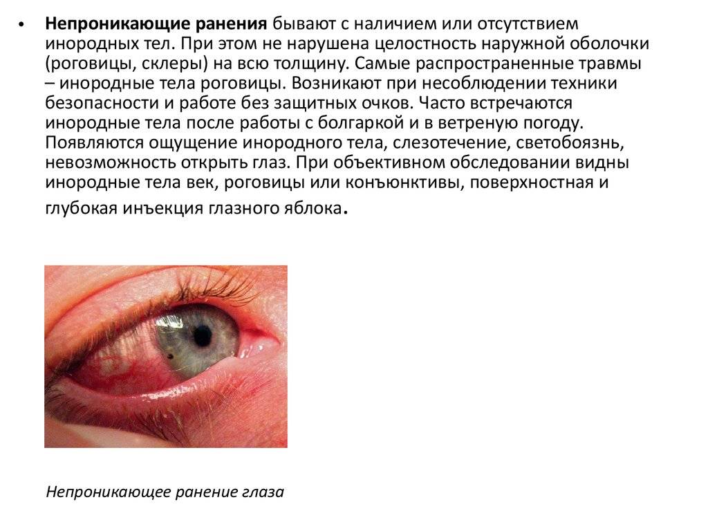 Микрофтальм (yменьшение глазного яблока): причины и лечение