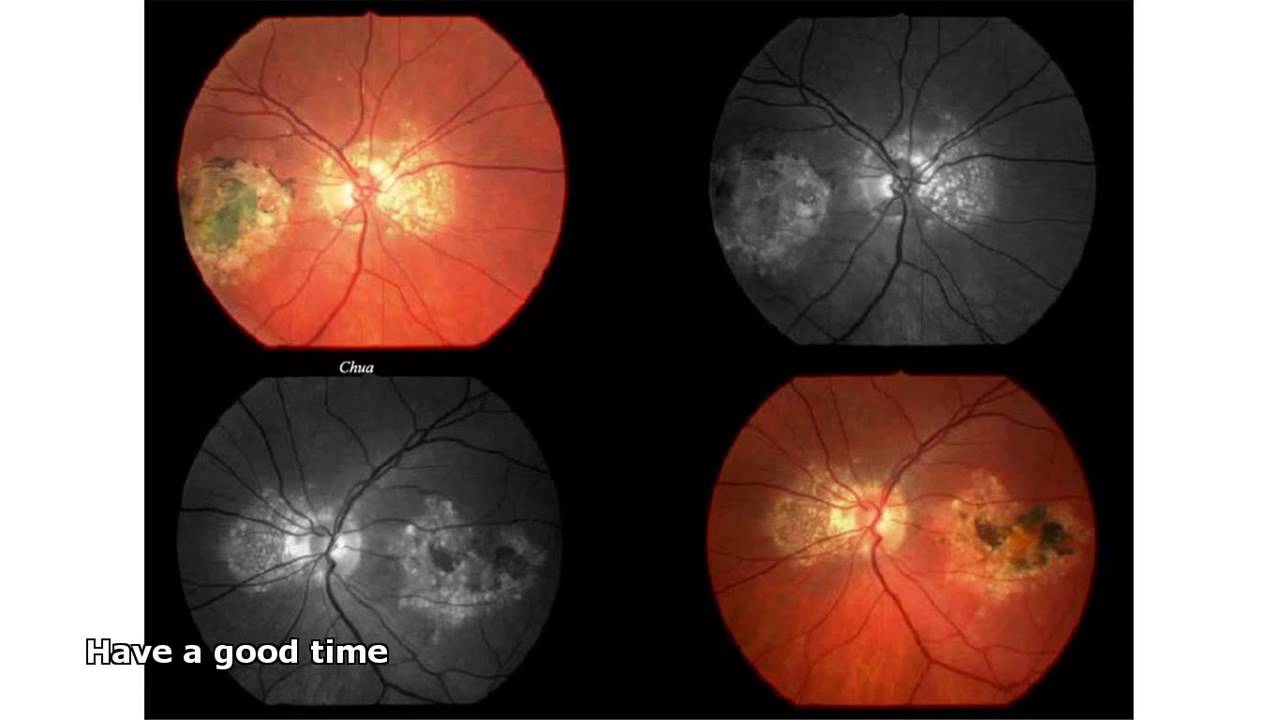 Периферическая дегенерация сетчатки глаза: причины, симптомы, лечение