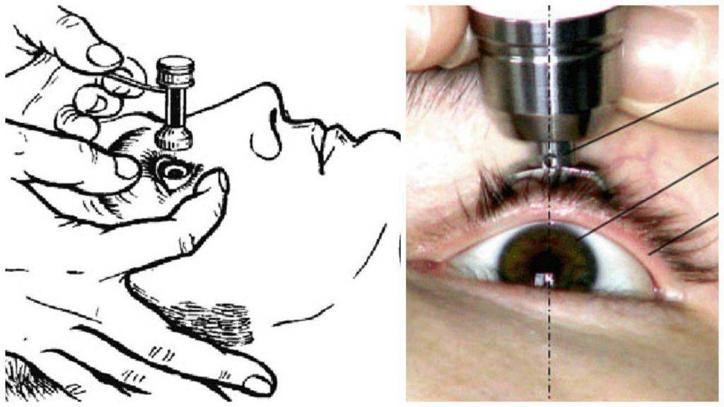 Тонометрия по маклакову и другие методы диагностики глаукомы