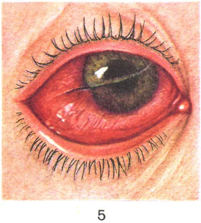 Травмы роговицы и слизистой глаза: симптомы, первая помощь, лечение