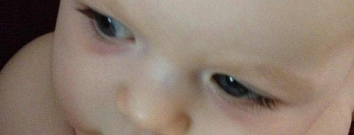 Синяки под глазами у ребенка - как вылечить темные круги под глазами у грудничка