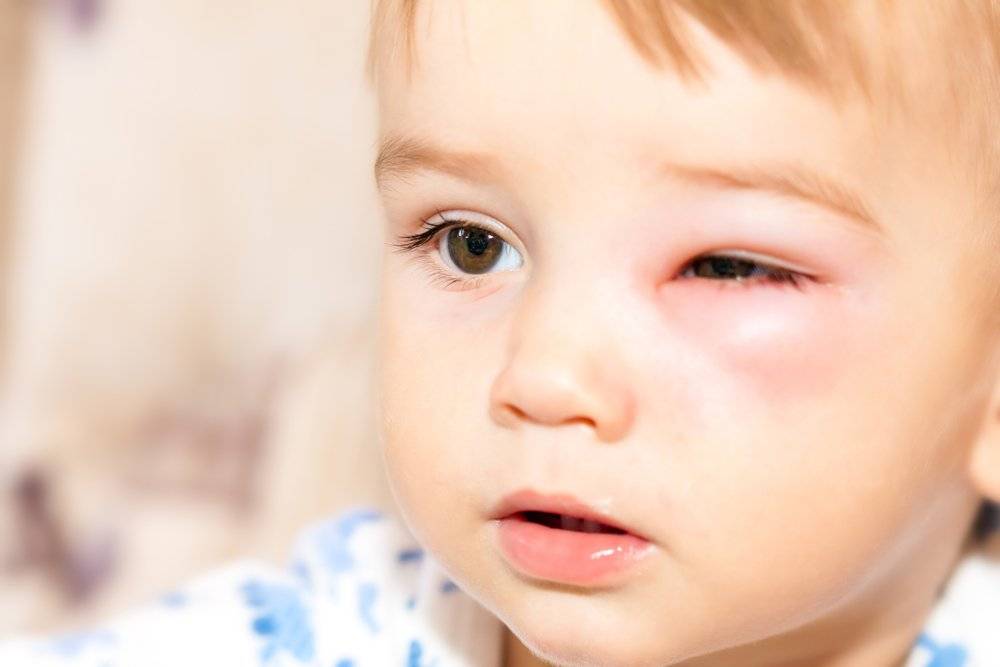 Аллергия на веках: причины, симптомы, лечение, меры профилактики