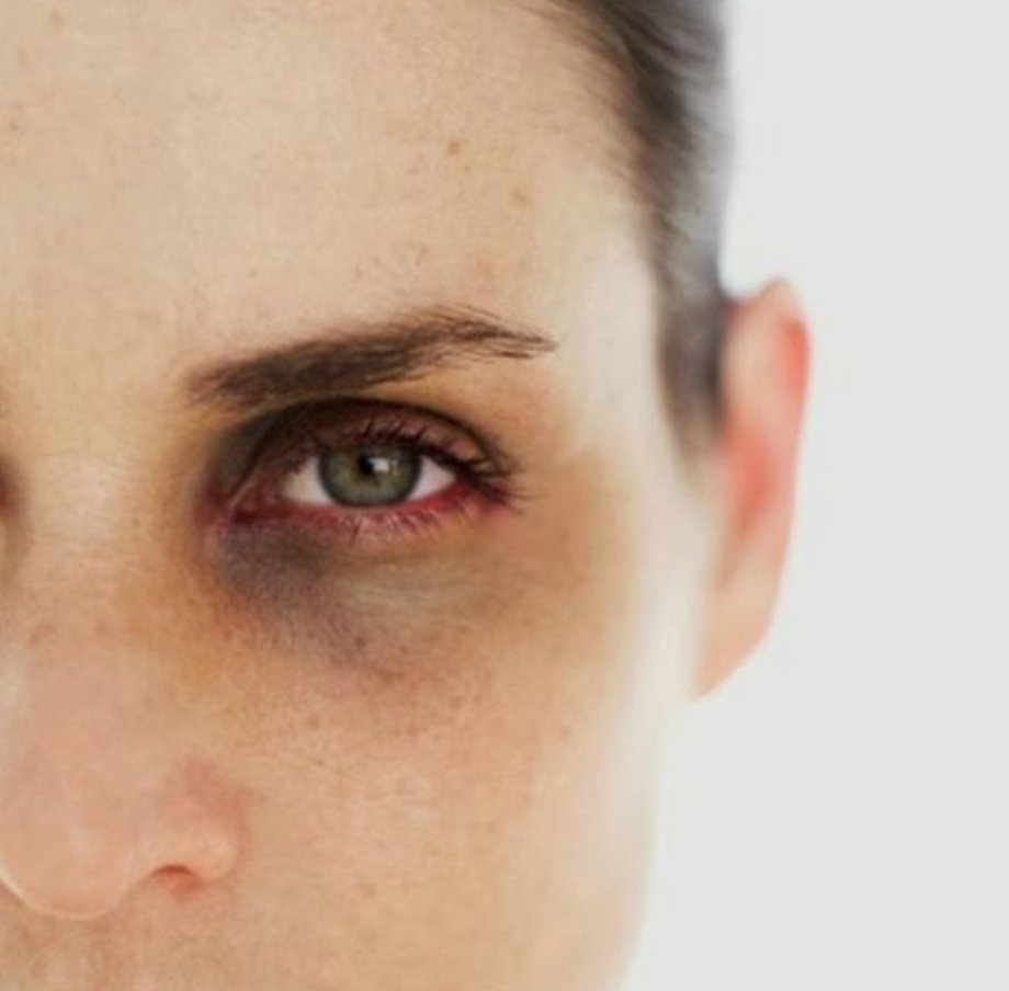 Почему появляются синяки под глазами у мужчин и как от них избавиться?