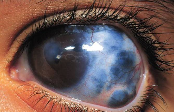 Глаукома. врожденная, вторичная и первичная глаукомы.
