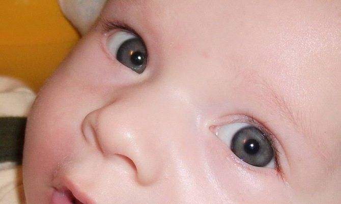 У ребенка покраснел белок глаза: причины возникновения точек, сосудов, пятен (в том числе у новорожденных) и рекомендации для родителей