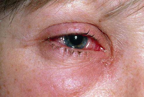Химический ожог глаза - лечение, первая помощь, последствия