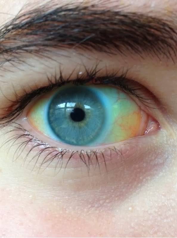Голубой белок глаза что означает. почему у ребенка серые белки глаз - про здоровье