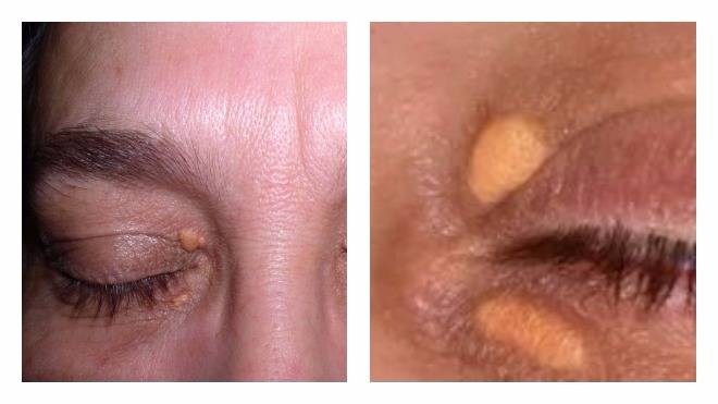 Причины появления и методы удаления желтых пятен на веках глаз