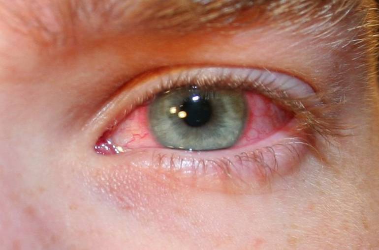 5 заболеваний, при которых глаз красный и гноится у взрослого. как лечить заражение?