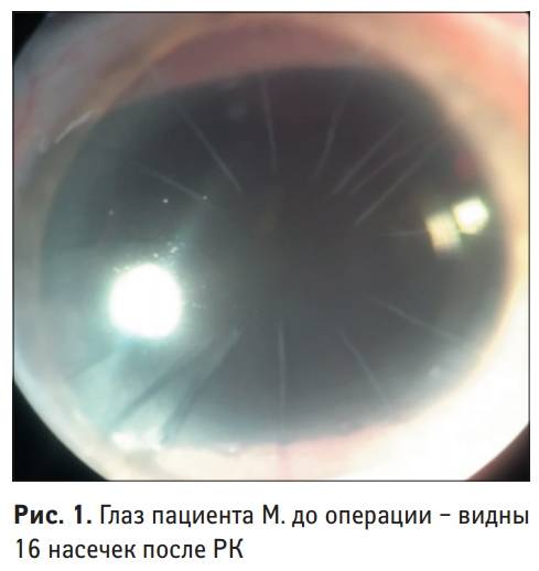 Восстановление зрения путём операции: суть кератотомии