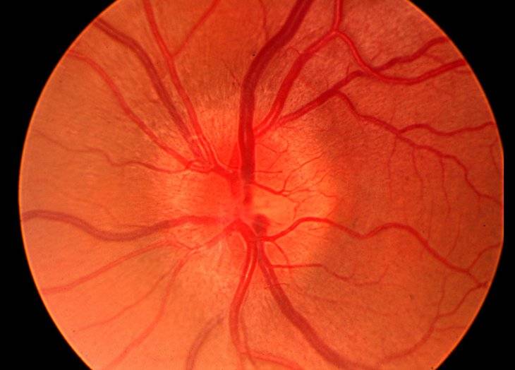 Неврит зрительного нерва – причины, симптомы, эффективное лечение