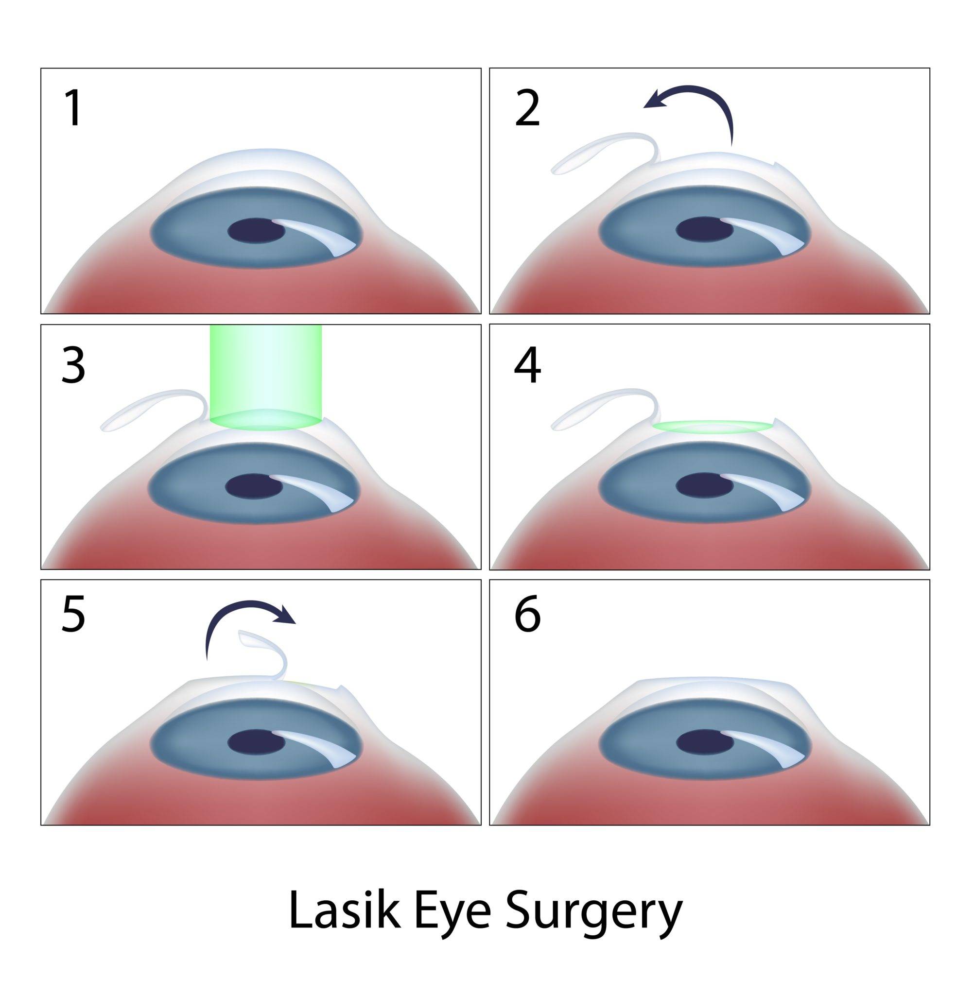 Консультация офтальмолога: может ли ухудшиться зрение после лазерной коррекции?